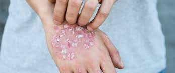 الصدفية Psoriasis