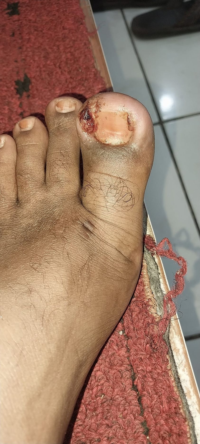 الضافر الناشب ( المنغرز)