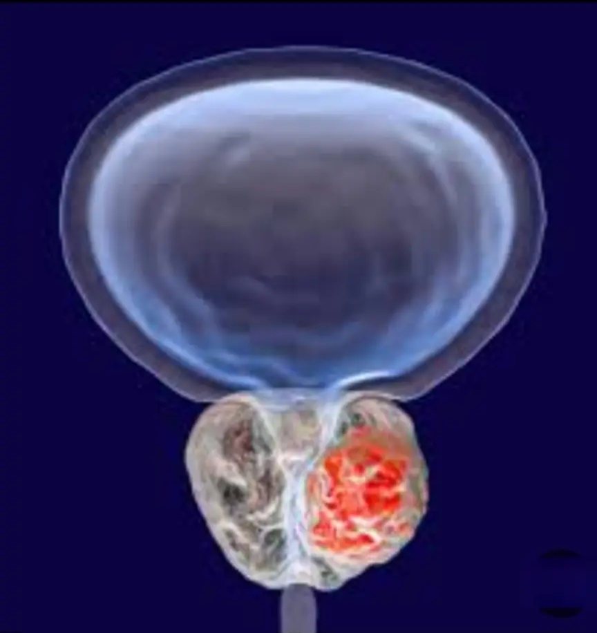حملة توعوية ويوم مجاني للكشف المبكر عن سرطان البروستاتا بمستشفي المعونة بجوبا  